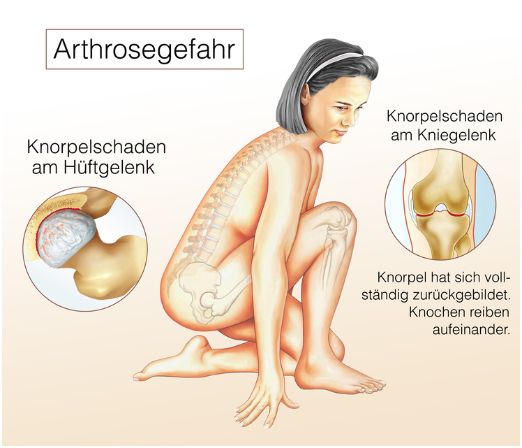 Arthrosegefahr im Kniegelenk und Hüftgelenk